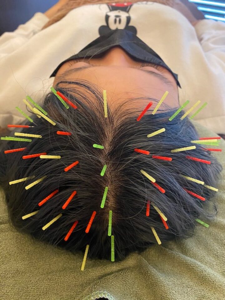 門前仲町のリノア鍼灸院で髪の毛のお悩みを解決の画像